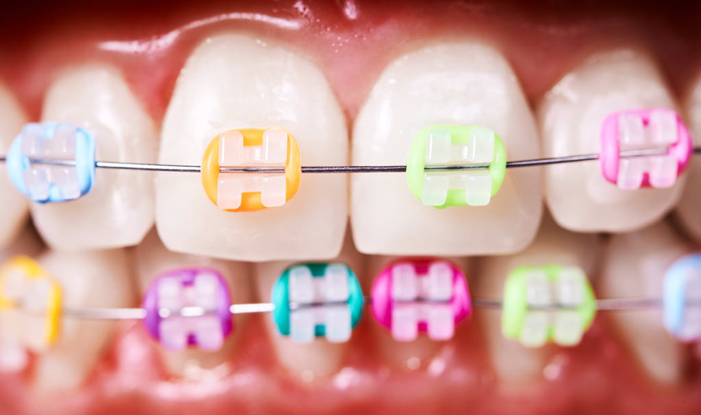 Zahnfarbene Keramik-Brackets